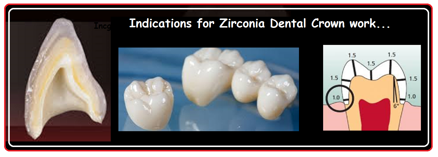 Indications For Zirconia Cad Cam Crown And Bridge Work