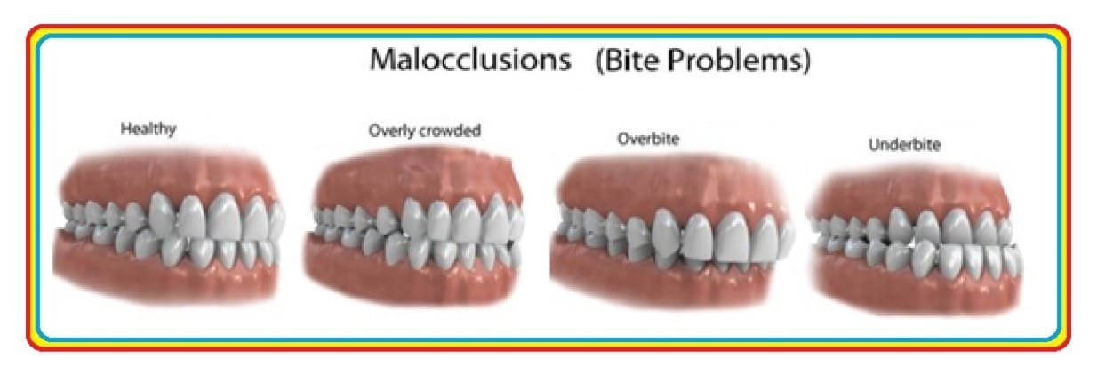 What are the causes of having a “bad bite” ? - Zirconia Dental Crowns ...