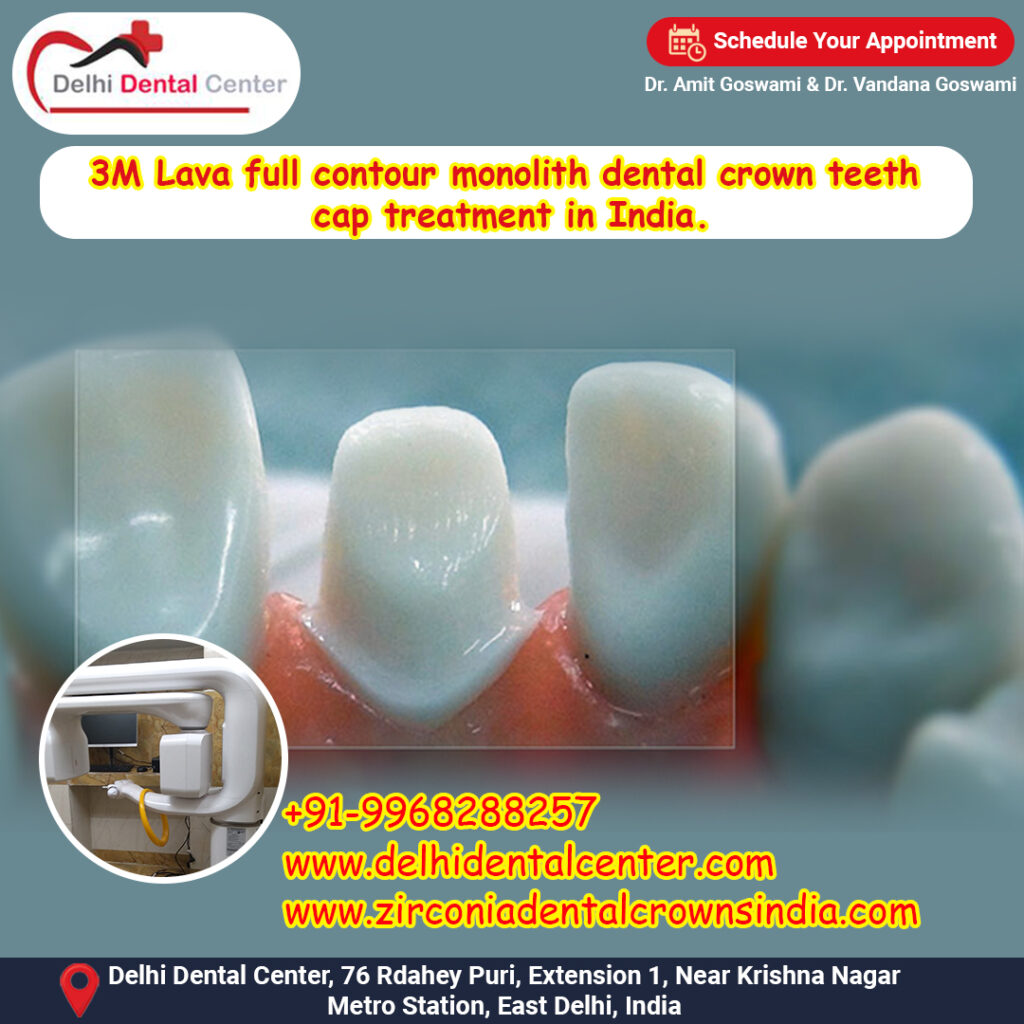 Zirconia CAD CAM Metal free Porcelain Ceramic Dental Crowns, What is the life span of CAD CAM metal free zirconia all ceramic full porcelain dental crowns in India.