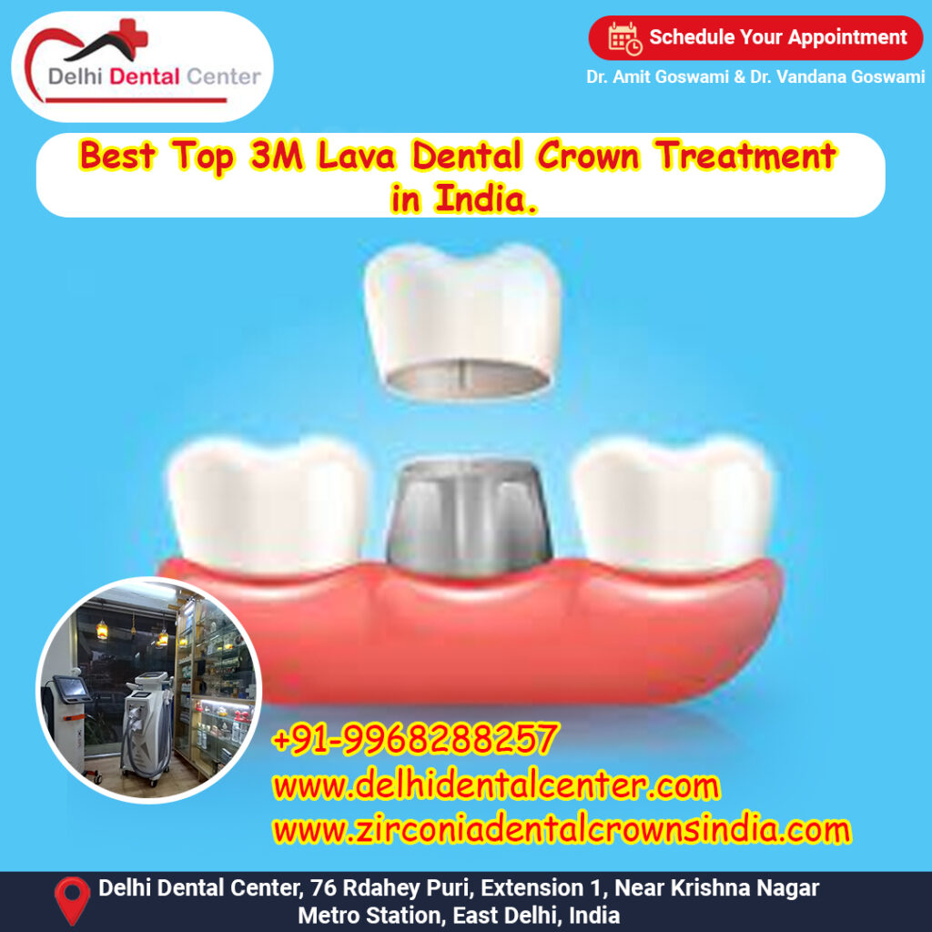 Zirconia CAD CAM Metal free Porcelain Ceramic Dental Crowns, What is the life of Zirconia CAD CAM Metal free all ceramic full porcelain Dental Crowns in India.