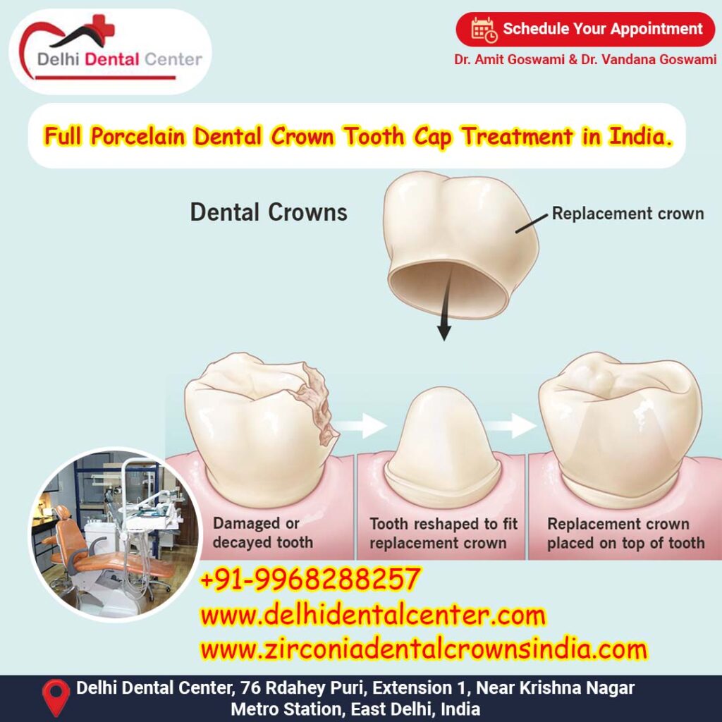 Zirconia CAD CAM Metal free Porcelain Ceramic Dental Crowns, Zirconia Dental crown in India.